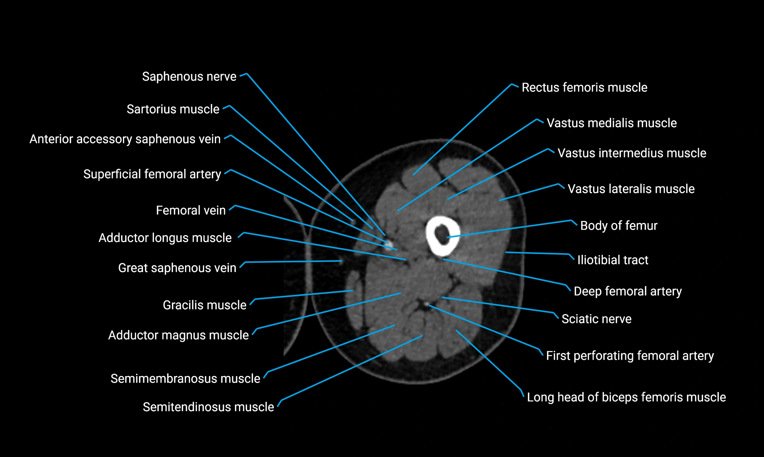 CT thigh axial cross sectional anatomy labelled image_50 (2).webp